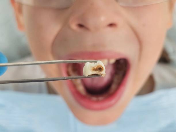 Best Emergency Treatment for Toothache in Surgoinsville, TN