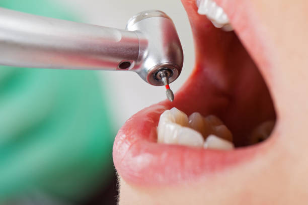 Best Emergency Tooth Extraction in Surgoinsville, TN